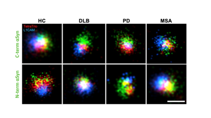 Fluorescence microscopy images comparing C-terminal and N-terminal alpha-synuclein staining across healthy controls (HC) and samples from DLB, Parkinson’s disease (PD), & multiple system atrophy (MSA). Red, green, & blue signals show protein localisation