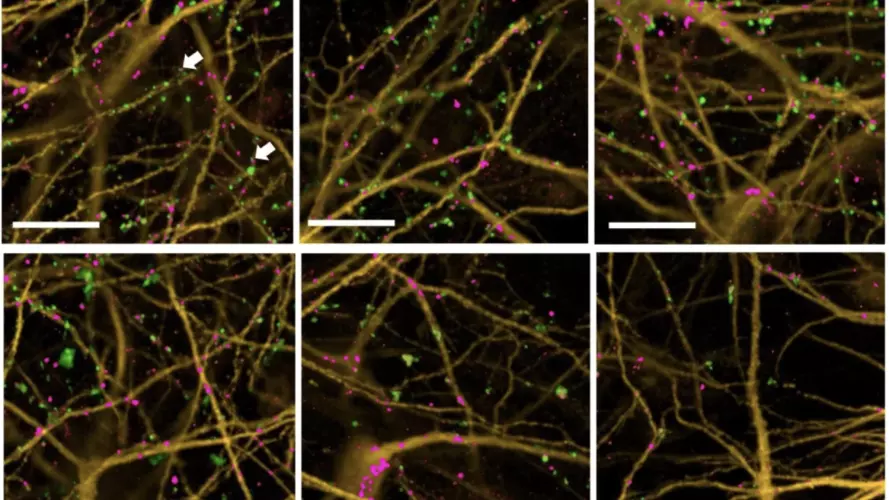Synapses, shown as green and pink dots, represent points of communication between neurons, grown here in the laboratory from stem cells. The study found that neuronal cultures from some Alzheimer's patients were more resilient to synapse loss after exposu